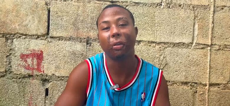 Joven pide ayuda para cirugías por graves quemaduras sufridas de bebé